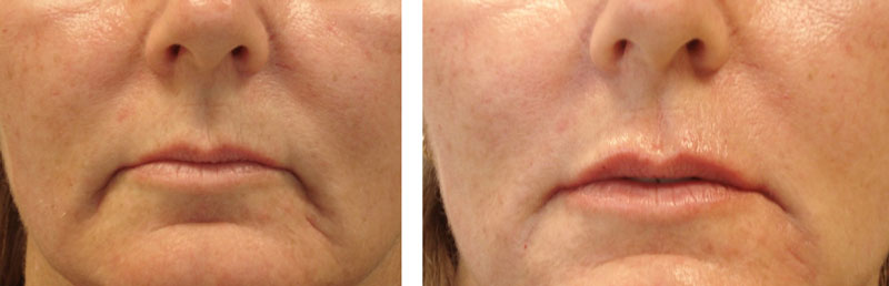 non surgical facelift