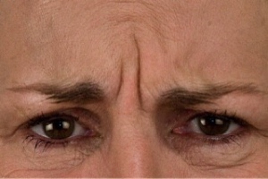 botox auckland botox auckland